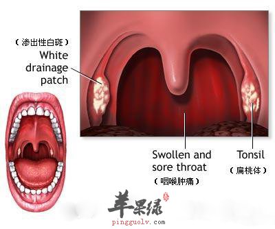 因为慢性咽炎并非细菌感染,滥用抗生素可能导致咽喉部正常菌群失调