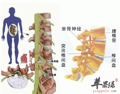 腰椎间盘突出的中药偏方二则