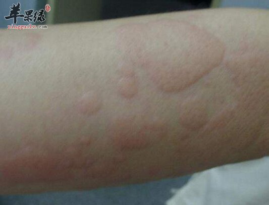苹果绿 保健常识血清病性荨麻疹:是由于药物(青霉素,痢特灵等),疫苗或