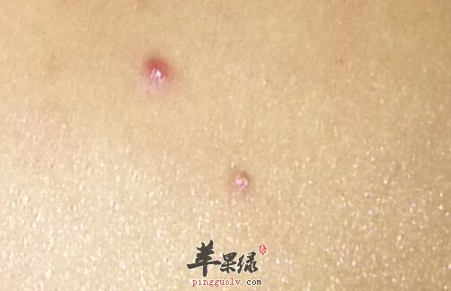 疥疮的小偏方_疥疮是如何引起的_疥疮如何治