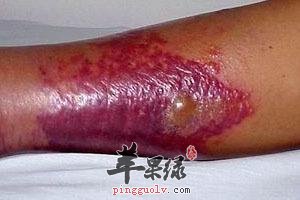 1,丹毒经常会发生在人体的小腿,颜面部位.会出现