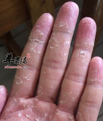 手癣是一种由于真菌感染而引发的手部皮肤疾病,而引起手癣的真菌主要