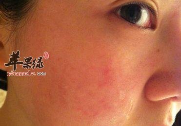 脸部皮肤过敏发红饮食要注意什么