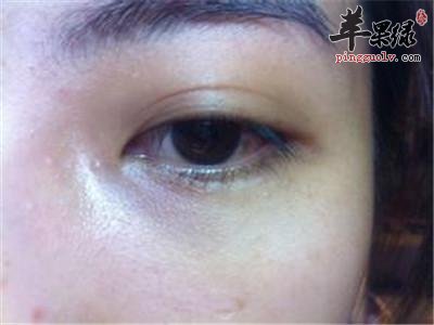如何有效的去除脂肪粒