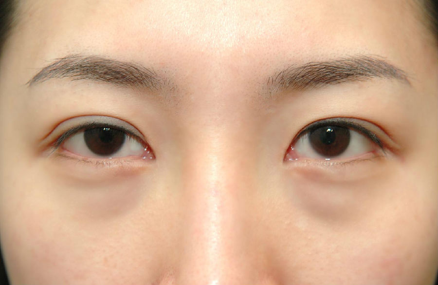 天生的下眼袋手术处理更好