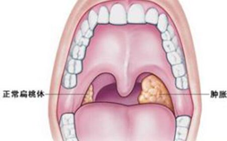 扁桃体发炎的症状