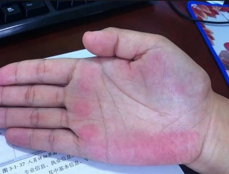 在平时生活中紫红色的手掌或者是手掌的颜色极其深的话一般的都是患有