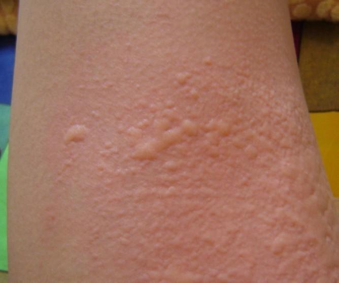 淋巴结肿大,且其发展具有阶段性,但是荨麻疹发病时皮肤鼓起大包,像