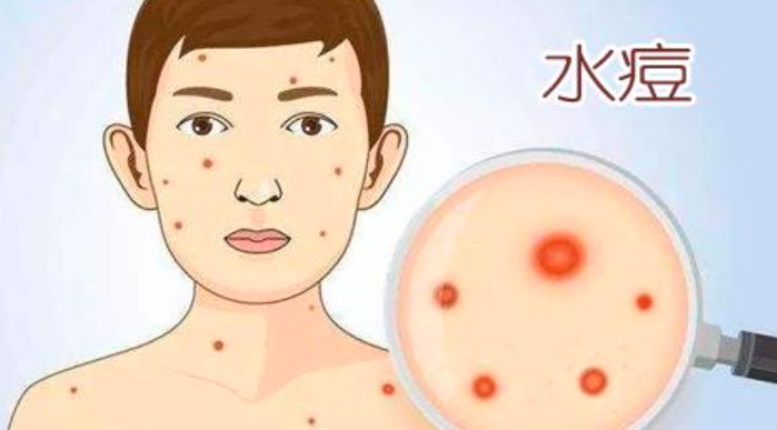苹果绿 保健常识水痘是一种急性传染病,由水痘带状疱疹病毒引起,会