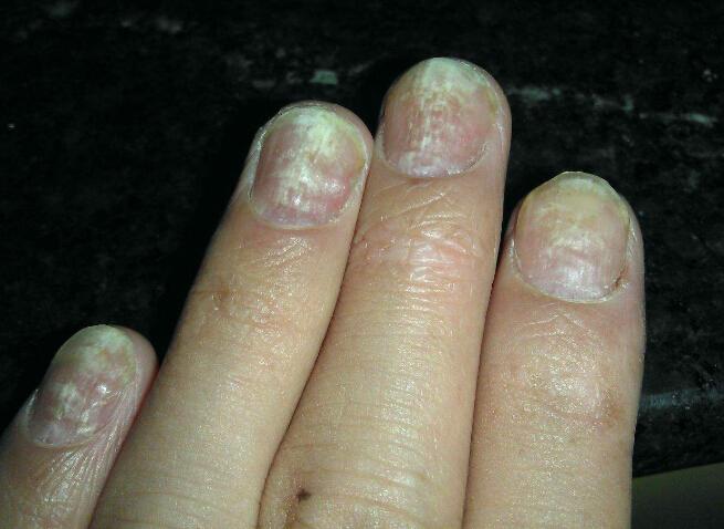 灰指甲有两种常见类型:真菌性灰指甲(浅白色灰指甲).