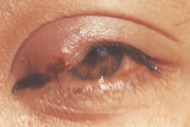 麦粒肿俗称针眼,主要指的是在睫毛毛囊附近出现皮脂腺的急性化脓性