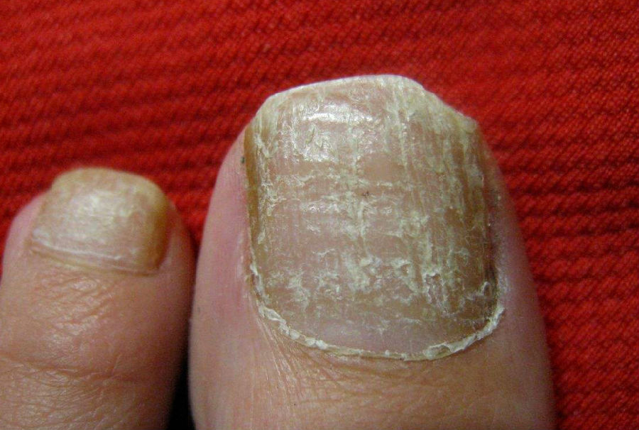 苹果绿 保健常识 灰指甲主要是由于人体出现真菌感染所引发的疾,如果