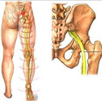 中医治疗老年性坐骨神经痛