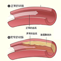 老年人为什么容易出现动脉硬化