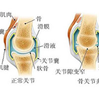 冬季如何防治关节疾病