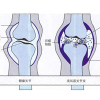 冬季防治关节炎我们可以这样做