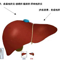 杜绝脂肪肝,从细节点滴入手