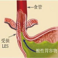 反流性食管炎的预防与调养