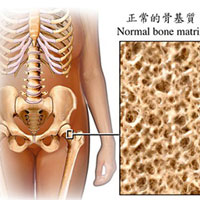 看看您离骨质疏松有多远