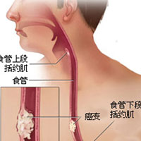 食管肿瘤的防治