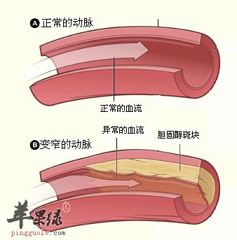 动脉硬化