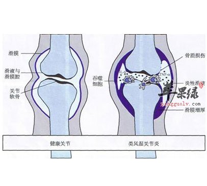 冬季防治关节炎我们可以这样做