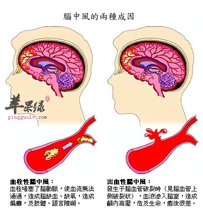 中风大脑分析图