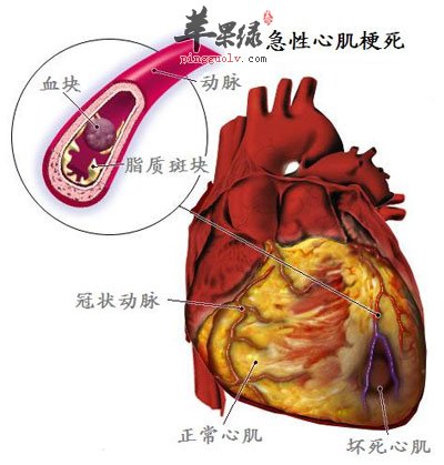 心肌梗死图片