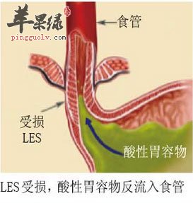 酸性胃容物反流入食管