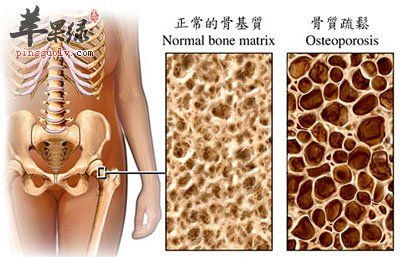 正常骨质和骨质疏松的对比