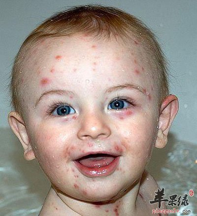 小孩子带状疱疹.jpg