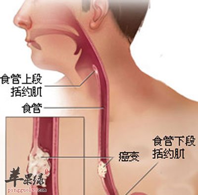 食管肿瘤