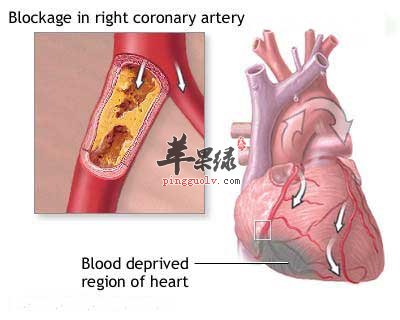冠状动脉粥样硬化.jpg