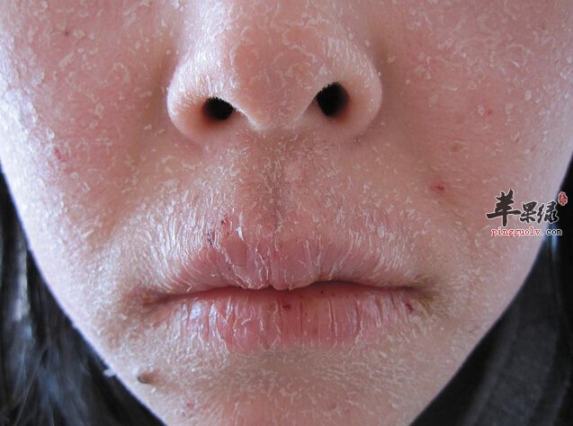 湿疹吃什么好得快