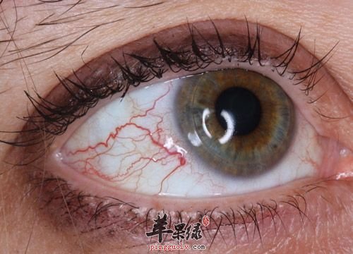 眼睛出血丝 眼睛当中有血丝怎么一回事 眼睛出血丝的解决方法 苹果绿