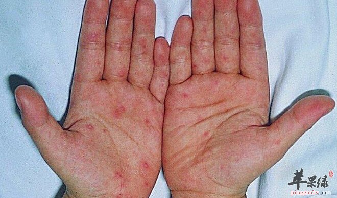 手足口病的症状