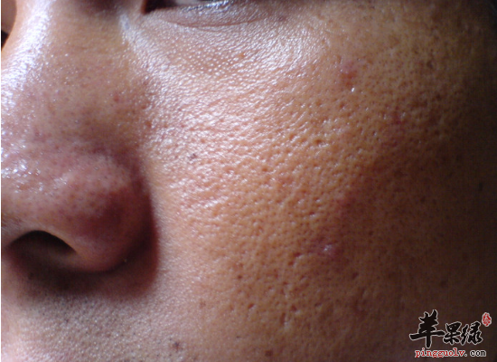 女生想要去黑头有哪些好办法