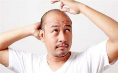 男性如何防治脱发症