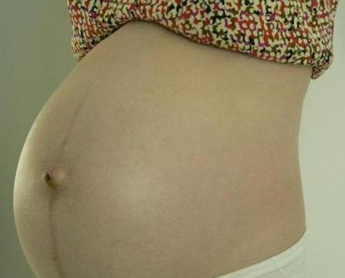 为什么孕妇容易出现妊娠纹