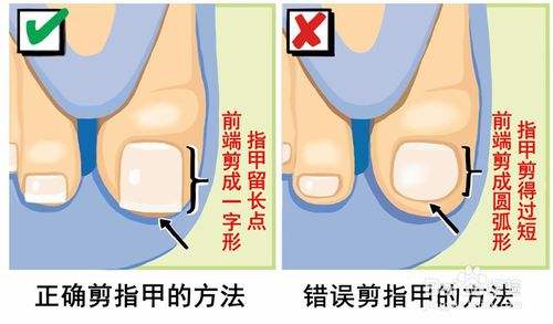 甲沟炎怎么剪指甲