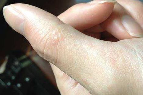 湿疹 水疱 手 手湿疹が治らない人のための手湿疹の治し方ナビ