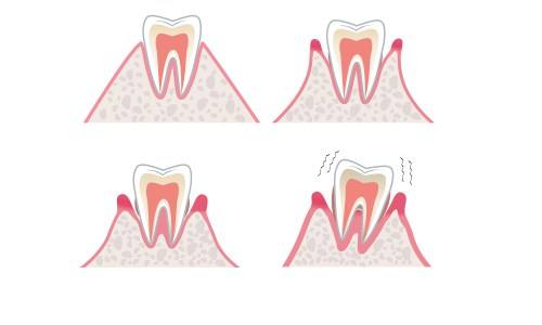 牙齿松动的原因