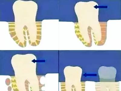 牙齿松动可以恢复吗