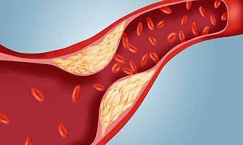 血管硬化斑块怎么办