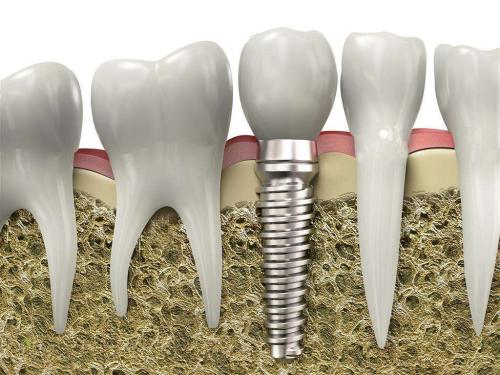 种植牙延长寿命的方法