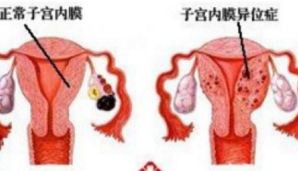 子宫移位怎么办