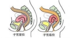 子宫移位是怎么回事