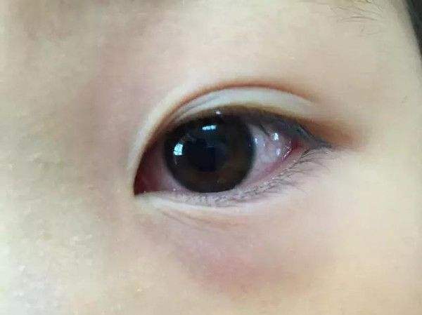 小孩有黑眼圈怎么办