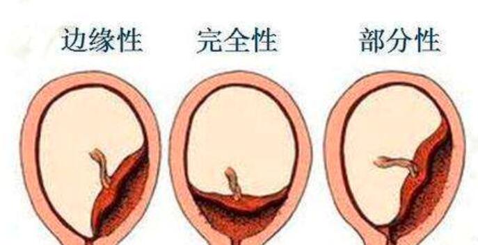 胎盘低怎么护理