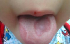 小孩舌头溃疡怎么办_小孩舌头溃